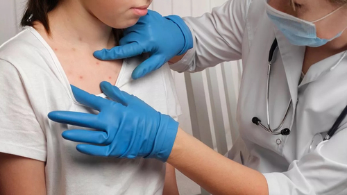 Ultime notizie aziendali su Il morbillo: si diffonde rapidamente.