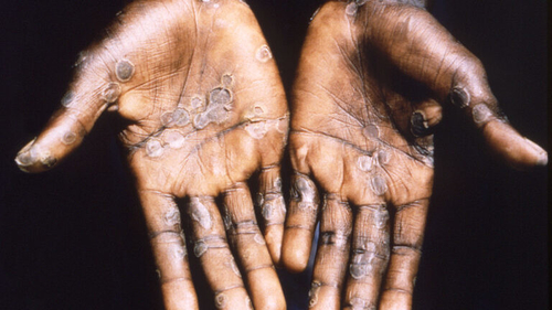 Latest company news about Lo scoppio di Monkeypox comporta “il rischio moderato” alla salute pubblica globale, il WHO dice